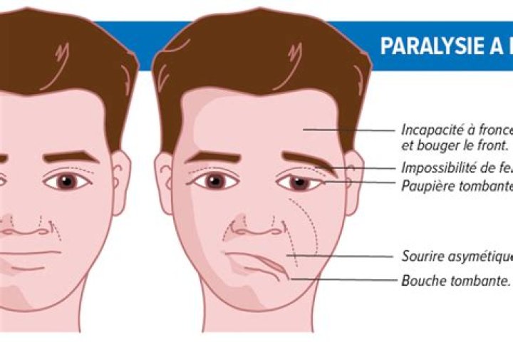 Pourquoi paralysie facial ?