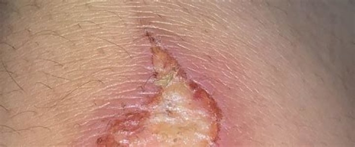 What does slough tissue look like?
