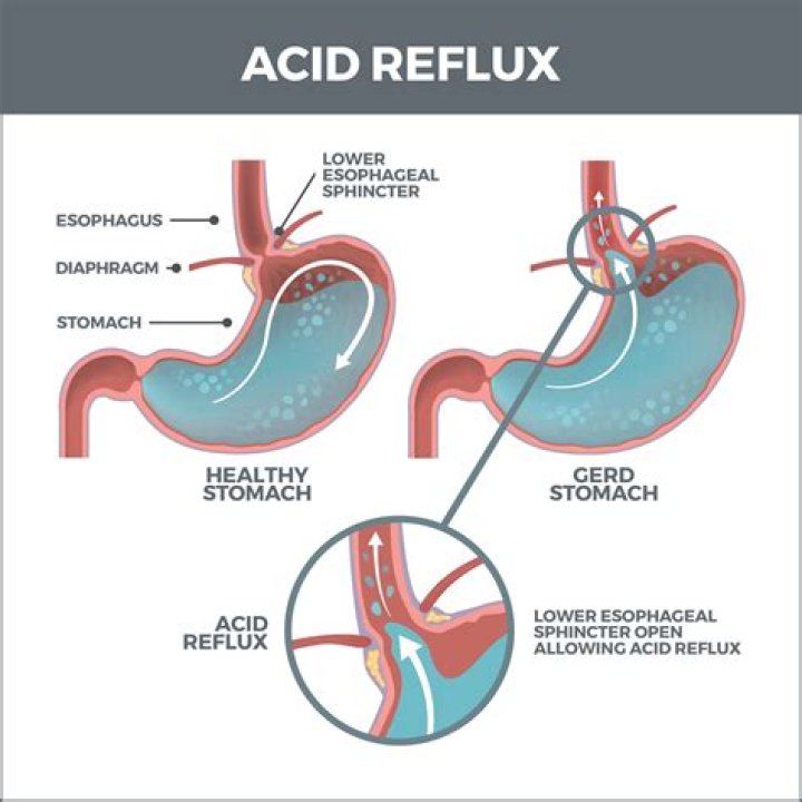 Why does reflux cause a reaction?